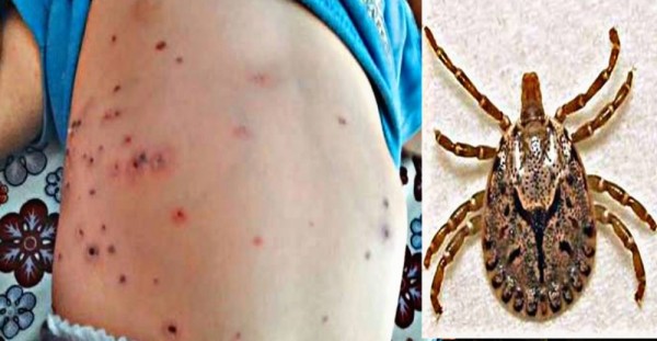 स्क्रब टाइफसबाट चार जनाको मृत्युमध्ये एकजना चितवनको